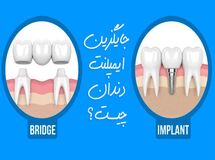 بهترین جایگزین ایمپلنت دندان چیست؟